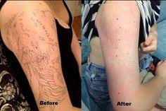 By shattering the ink into even smaller particles, the laser. 17 Picosure Before After Ideas Laser Tattoo Removal Tattoo Removal Laser Tattoo