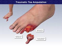 Image result for toe amputation