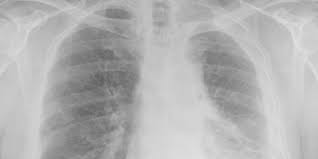 It mainly affects the lining of the lung and chest cavity (pleura) or lining of the . Malignant Mesothelioma Mortality United States 1999 2015 Mmwr