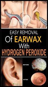 Easy Removal Of Earwax With Hydrogen Peroxide Hussis Ear Wax Ear Wax Removal Hydrogen Peroxide