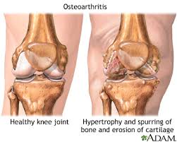 Restless Legs Syndrome And Related Disorders In Depth Reports St Luke S Hospital