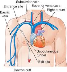 Full Size Picture C17 Jpg Central Venous Catheter Catheter Pediatric Nursing