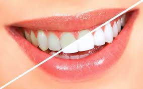 Image result for Tooth Discoloration