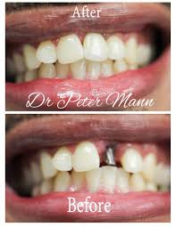 Image result for dental implant