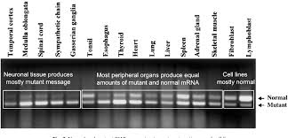 Etwa eine von 30 personen in dieser bevölkerungsgruppe ist ein konduktor. Familial Dysautonomia Riley Day Syndrome When Baroreceptor Feedback Fails Semantic Scholar