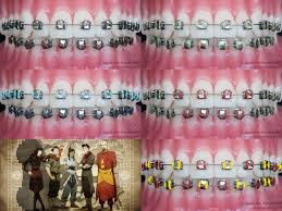 Pin By Laurie Lexie Lee On Braces Colors Braces Teeth Colors Teeth Braces Cute Braces Colors