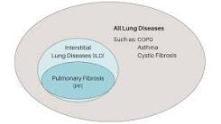 Image result for icd 9 code for interstitial fibrosis
