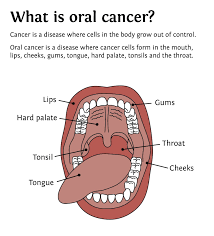 This is called oropharyngeal cancer. Pin On Oral Hygiene