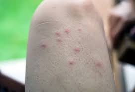 Image result for mosquito bite