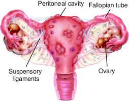 Endometriosis is more common in women who are having fertility issues, but it does not necessarily cause infertility. Endometriosis Taber S Medical Dictionary