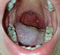 Throat cancer is a condition that is characterized by the development of malignant tumors in the throat (pharynx), voice box (larynx) or tonsils. Is This Throat Cancer Images Cancer Forums Patient