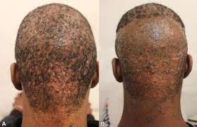However, one glance at the mirror may bring it down if you have a skin. Selection Criteria And Techniques For Improved Cosmesis And Predictable Outcomes In Laser Hair Removal Treatment Of Acne Keloidalis Nuchae Jaad Case Reports