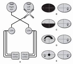 Image result for Visual Field Deficit