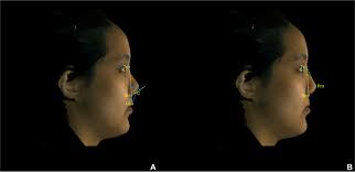 Patient- and 3D morphometry-based nose outcomes after skeletofacial  reconstruction