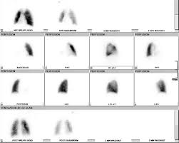 Image result for Ventilation Perfusion Scan