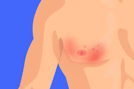 Image result for Inflammatory breast cancer