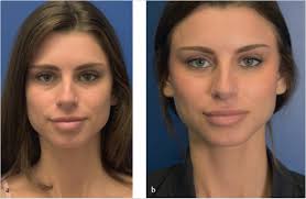 55 Part B: Filler Finesse: Cheeks