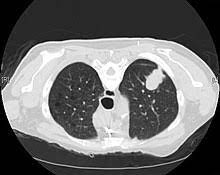 They appear due to scarring caused by a previous infection or a benign tumor. Adenocarcinoma Of The Lung Wikipedia