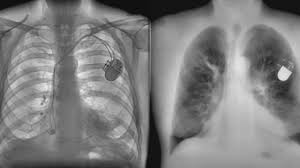 Lung cancer screening uses a type of chest computed tomography (ct), known as low radiation dose ct (ldct), using reduced doses of radiation doctors use lung cancer screening for early detection of disease in former and current smokers who do not have symptoms. Canada Startup S Portable X Ray May Replace Lung Cancer Ct Scans