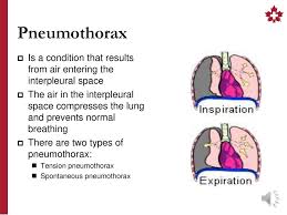 Underlying lung disease or mechanical ventilation can be a cause or a risk factor for a pneumothorax. Chest Injuries Intermediate Ppt Download
