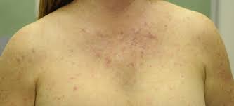 Image result for Photodermatitis