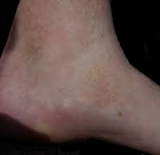 These discolored spots are caused by bleeding under the skin. Schamberg Disease Wikipedia