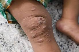 Image result for scabies human children