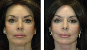 Eyelid Surgery Beverly Hills