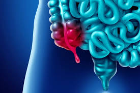 Image result for Appendicitis