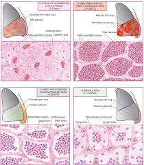 Lobar Pneumonia Pneumonia Aspiration Pneumonia Community Acquired Pneumonia