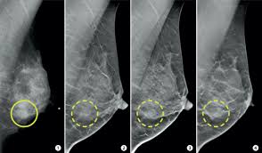 We did not find results for: 3 D Mammograms May Improve Accuracy Of Breast Cancer Screening