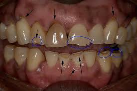 It can lead to all kinds of nasty things like headaches, tooth or jaw pain, damaged teeth, and disrupted sleep. How Does Your Dentist Know You Grind Your Teeth Charlotte Dentist