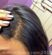 When the burning died down, they applied a sensitive skin formula of bleach that didn't burn and put me under a heater. Are These Chemical Burns Forums Haircrazy Com