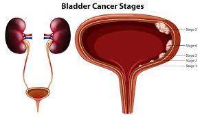 Understanding Urinary Bladder Cancer: Causes, Symptoms, Diagnosis ...