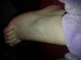 Es kann bei solchen sachen auch zu kleinen rissen und brüchen in den fußknochen kommen. Umgeknickt Hilfe Gesundheit Und Medizin Arzt Schmerzen