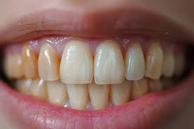 Image result for Tooth Discoloration