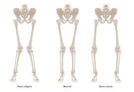 Image result for Genu Varum