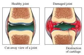 Lutut sakit atau nyeri lutut dapat disebabkan oleh cedera pada lutut. Sakit Lutut Kaki Kiri Archives Pengedar Vivix Shaklee