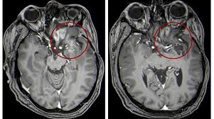 This guidance is for all children and young people up to their 25 th birthday. Unusual Treatment Shows Promise For Kids With Brain Tumors Asharq Al Awsat
