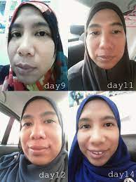 Sy pengguna digivet, aplikasi u klinik hewan, respon untuk membantu bila ada permasalahan bagus dan kalau kami ceritakan semua keunggulan vmedis, rasanya tidak cukup halaman testimoni ini. Eucerin Proacne Solution Merawat Jerawat Dengan Berkesan Sheila Inspire Lifestyle Blog