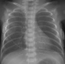 Mediastinum in neonate has much variability and mainly consist of heart and thymus…. Lung Disease In Premature Neonates Radiologic Pathologic Correlation Radiographics