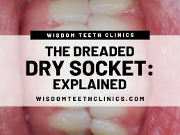 Once the tissue is able to cover the bone, the healing will progress normally. Dreaded Dry Socket Explained Wisdom Teeth Clinics