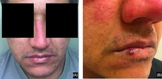 Cutaneous reactive B‐cell lymphoid proliferations