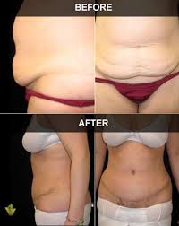 The average cost of a tummy tuck is $6,092, according to 2019 statistics from the american society of plastic surgeons. Cost Of A Tummy Tuck Ottawa On Abdominoplasty Dr Lacey Dr Macarthur