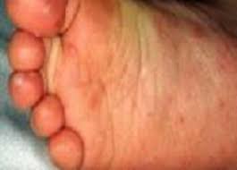 Ruam umumnya muncul pada telapak tangan dan kaki, dan juga dapat muncul pada bokong dan/atau kelamin. Soalan Lazim Faq Penyakit Tangan Kaki Dan Mulut Hand Foot And Mouth Disease Hfmd From The Desk Of The Director General Of Health Malaysia