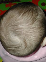 Skip to the end of the images gallery. Hair Whorl Wikipedia