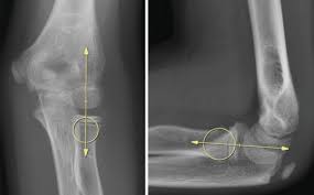 Image result for Radial Head Dislocation