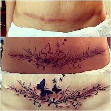 Whether you're looking for something as simple as a tummy tuck scar tattoo or something a little bolder to cover up a lingering reminder of something like a large burn, you'll find some awesome ideas to get your creative juices flowing below. Pin On Scar Tatoos