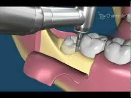 Wisdom Teeth Removal Extraction News Guides Wisdom Teeth Wisdom Teeth Removal Wisdom Tooth Extraction
