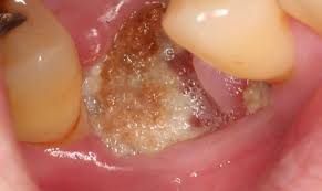 Image result for Tooth Extraction